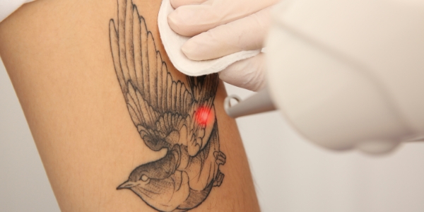 Laser Tattoo Removal Cost per Session Near Me