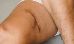 Accidental Scar
