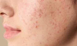 Acne Scar