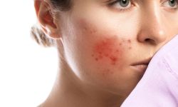Acne Treatment