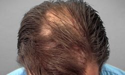 Androgenic Alopecia