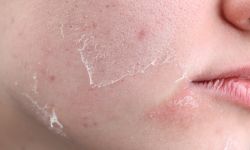 Dry and Lifeless Skin